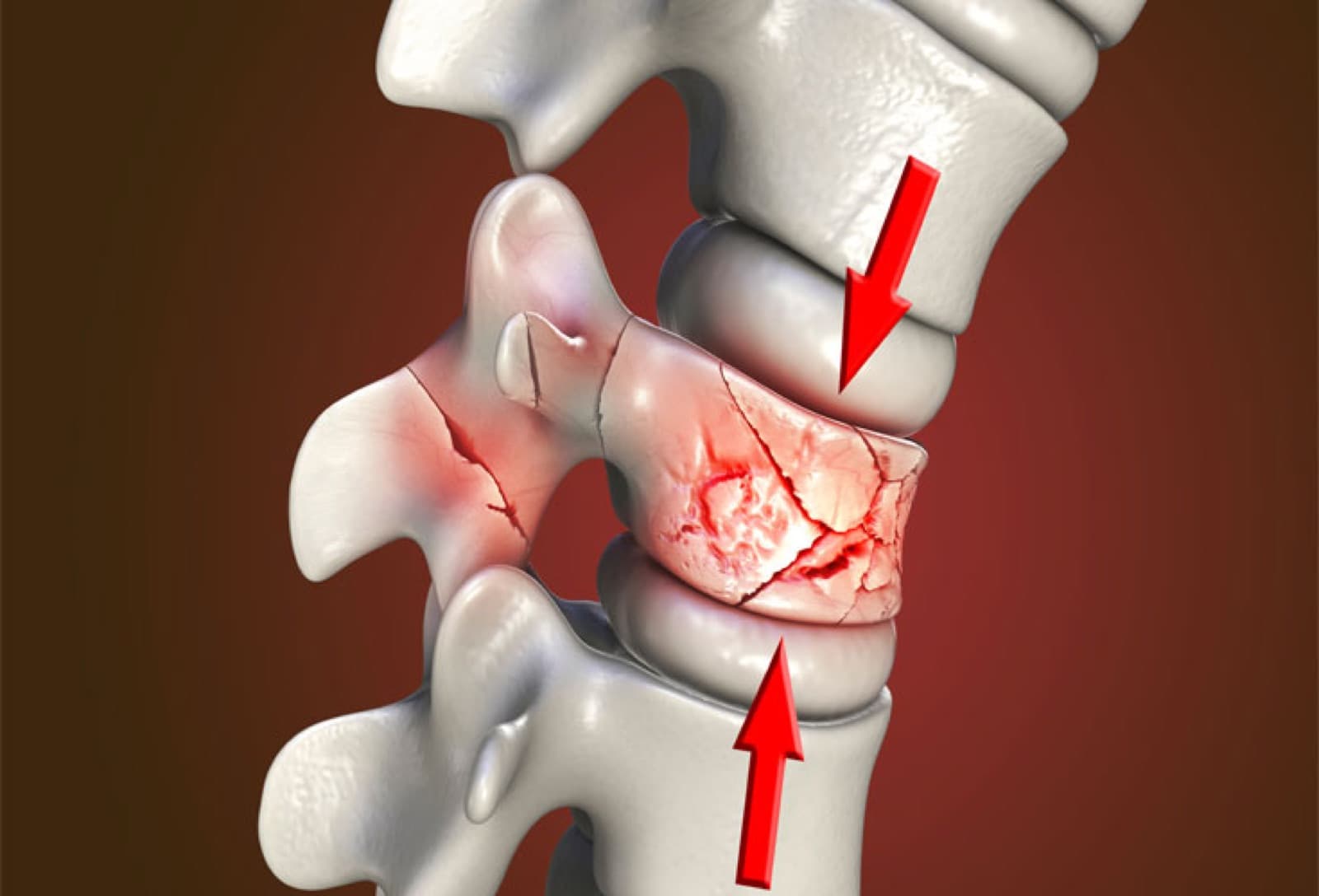 Thoái hóa cột sống - các phương pháp điều trị nội khoa và ngoại khoa