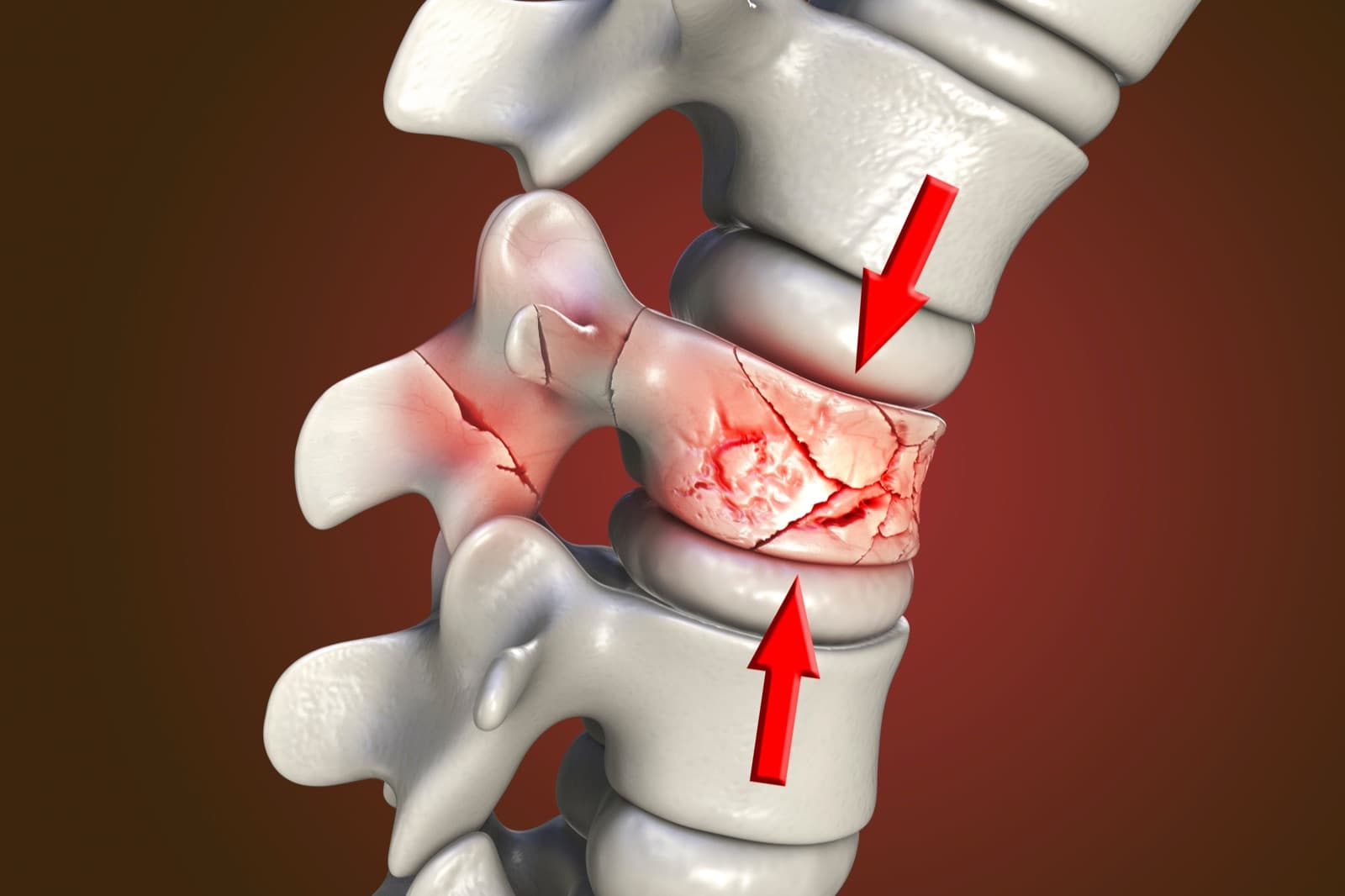 Thoái hóa cột sống: Những điều cần biết